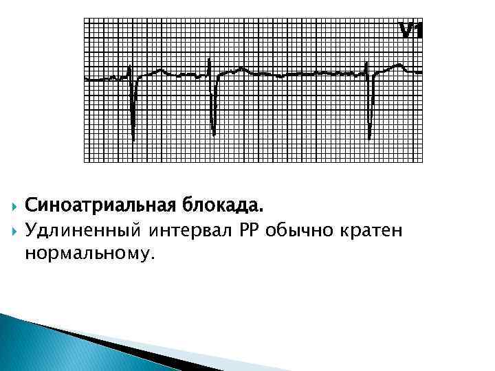 Признаки синоатриальной блокады. Блокада синоатриального узла. Синоатриальная блокада на ЭКГ. ЭКГ признаки синоатриальной блокады. Синоатриальная блокада 2 степени 1 типа на ЭКГ.