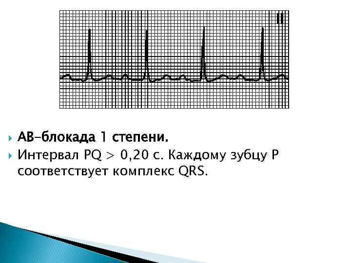  АВ-блокада 1 степени. Интервал PQ > 0, 20 с. Каждому зубцу P соответствует