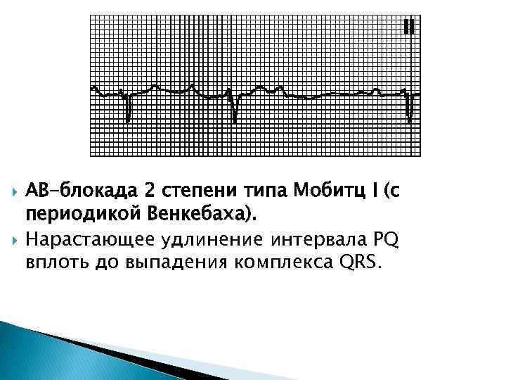  АВ-блокада 2 степени типа Мобитц I (с периодикой Венкебаха). Нарастающее удлинение интервала PQ