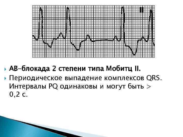  АВ-блокада 2 степени типа Мобитц II. Периодическое выпадение комплексов QRS. Интервалы PQ одинаковы