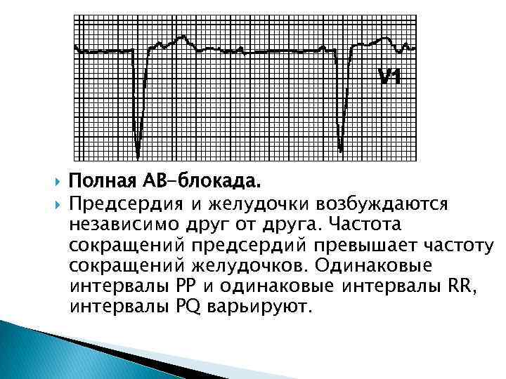  Полная АВ-блокада. Предсердия и желудочки возбуждаются независимо друг от друга. Частота сокращений предсердий