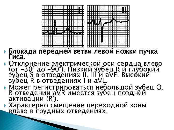  Блокада передней ветви левой ножки пучка Гиса. Отклонение электрической оси сердца влево (от