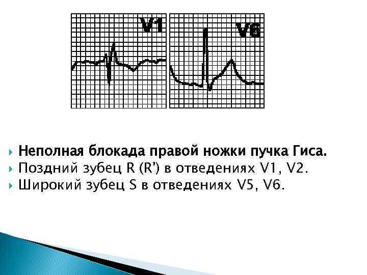  Неполная блокада правой ножки пучка Гиса. Поздний зубец R (R') в отведениях V