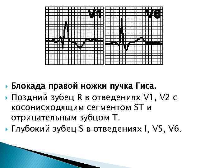  Блокада правой ножки пучка Гиса. Поздний зубец R в отведениях V 1, V