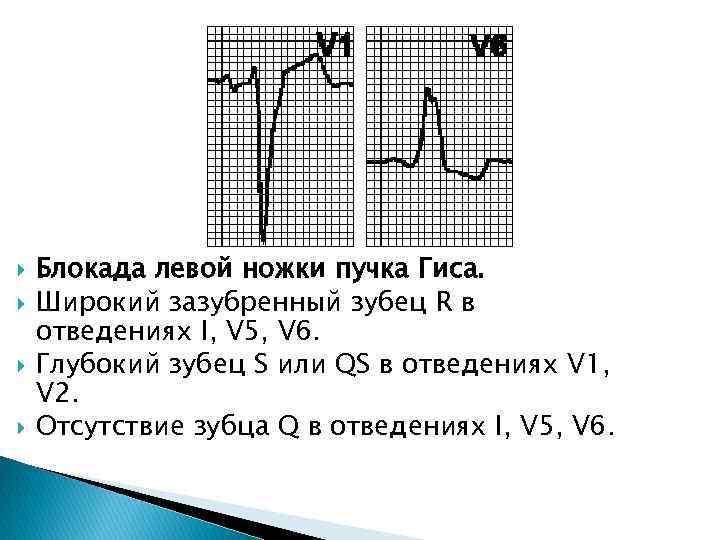  Блокада левой ножки пучка Гиса. Широкий зазубренный зубец R в отведениях I, V