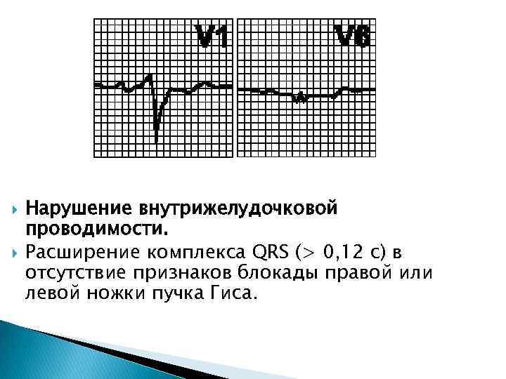  Нарушение внутрижелудочковой проводимости. Расширение комплекса QRS (> 0, 12 с) в отсутствие признаков