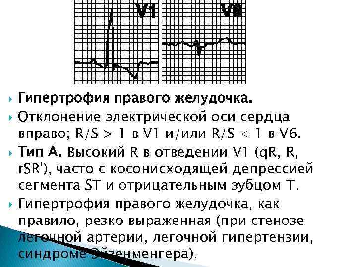 Экг резкое отклонение влево