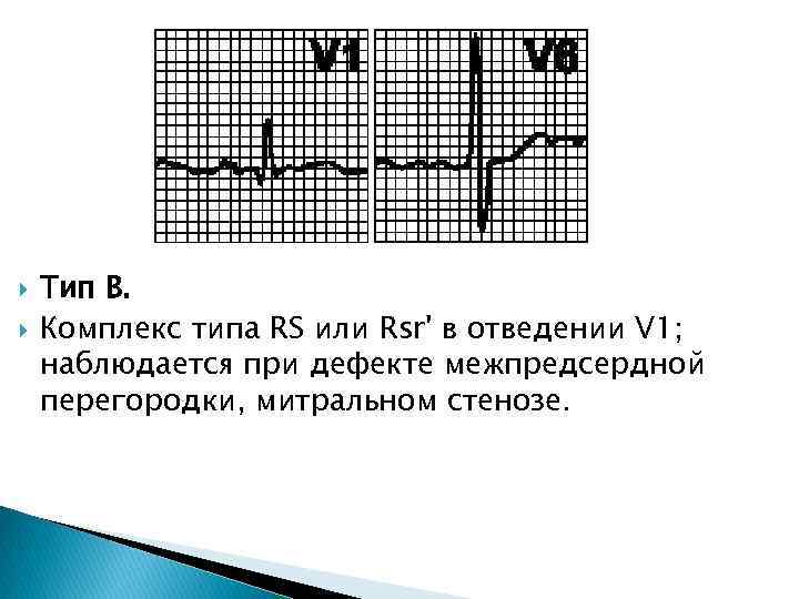  Тип B. Комплекс типа RS или Rsr' в отведении V 1; наблюдается при