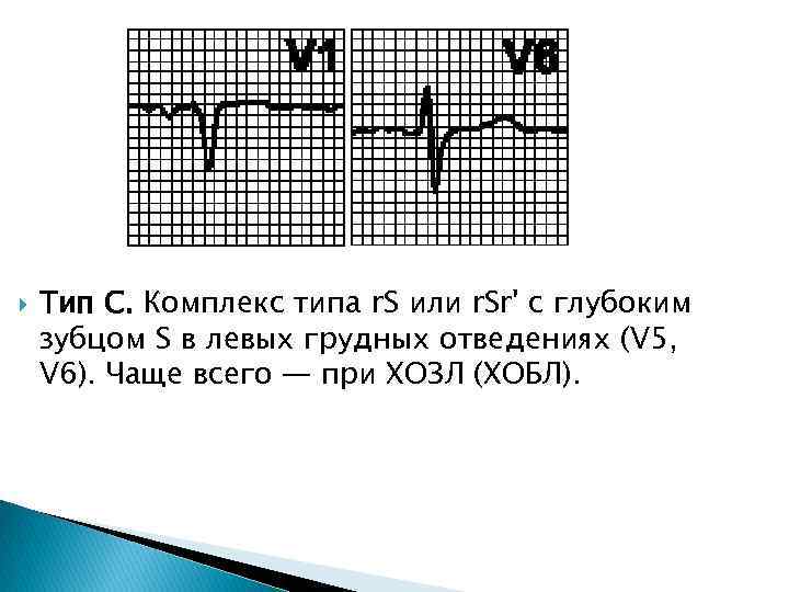  Тип C. Комплекс типа r. S или r. Sr' с глубоким зубцом S