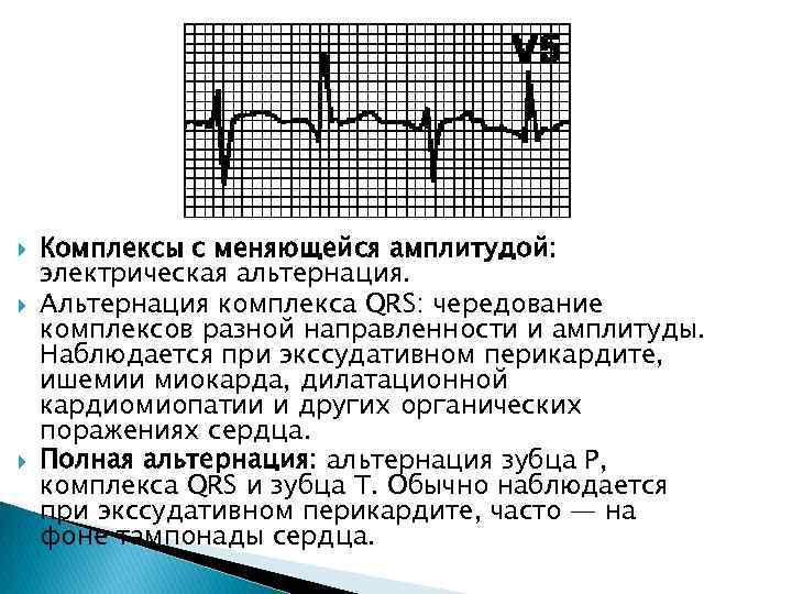  Комплексы с меняющейся амплитудой: электрическая альтернация. Альтернация комплекса QRS: чередование комплексов разной направленности