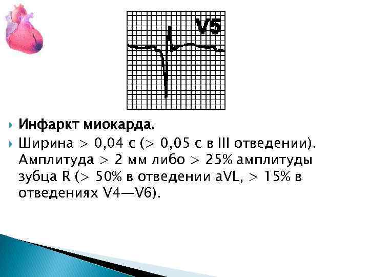  Инфаркт миокарда. Ширина > 0, 04 с (> 0, 05 с в III