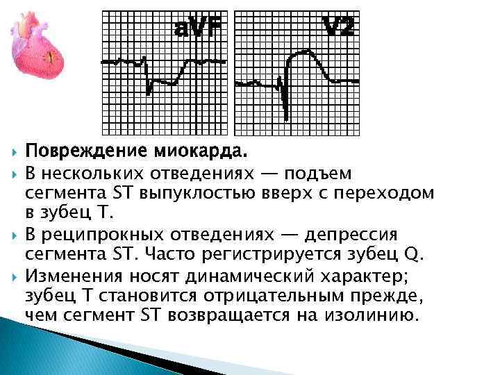 Повреждение миокарда без подъема st. Подъем сегмента St в отведениях. Подъем сегмента St над изолинией. St выше изолинии на ЭКГ.