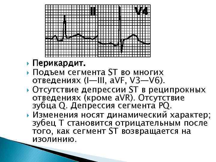  Перикардит. Подъем сегмента ST во многих отведениях (I—III, a. VF, V 3—V 6).