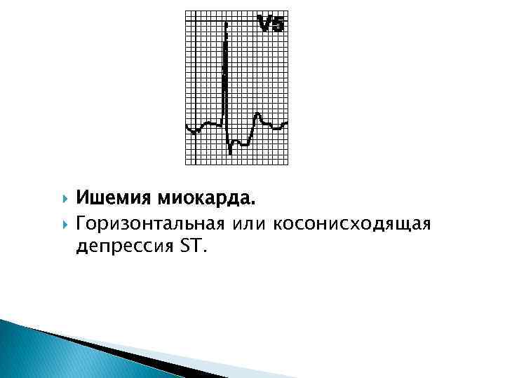  Ишемия миокарда. Горизонтальная или косонисходящая депрессия ST. 