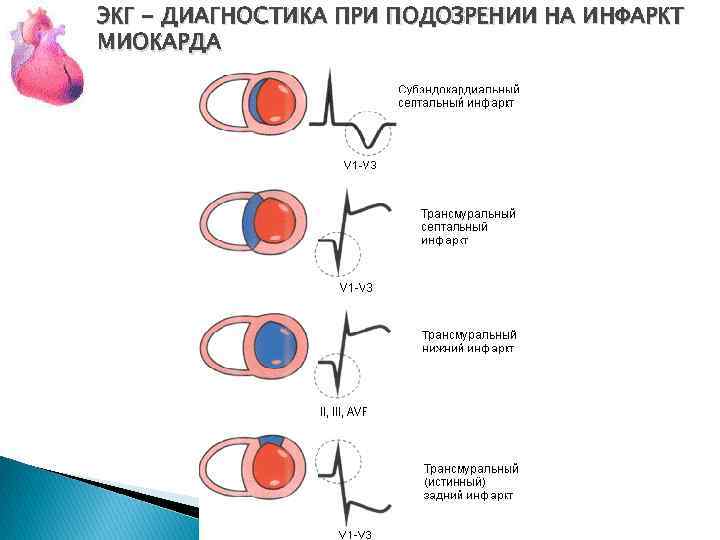 ЭКГ - ДИАГНОСТИКА ПРИ ПОДОЗРЕНИИ НА ИНФАРКТ МИОКАРДА 