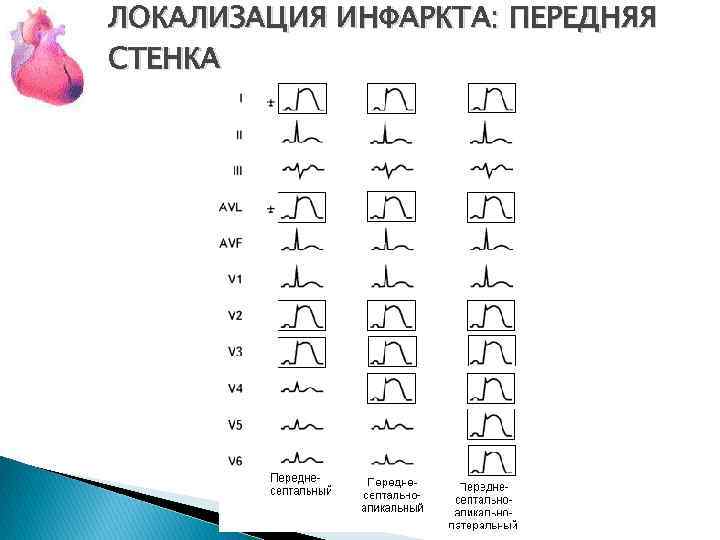 ЛОКАЛИЗАЦИЯ ИНФАРКТА: ПЕРЕДНЯЯ СТЕНКА 