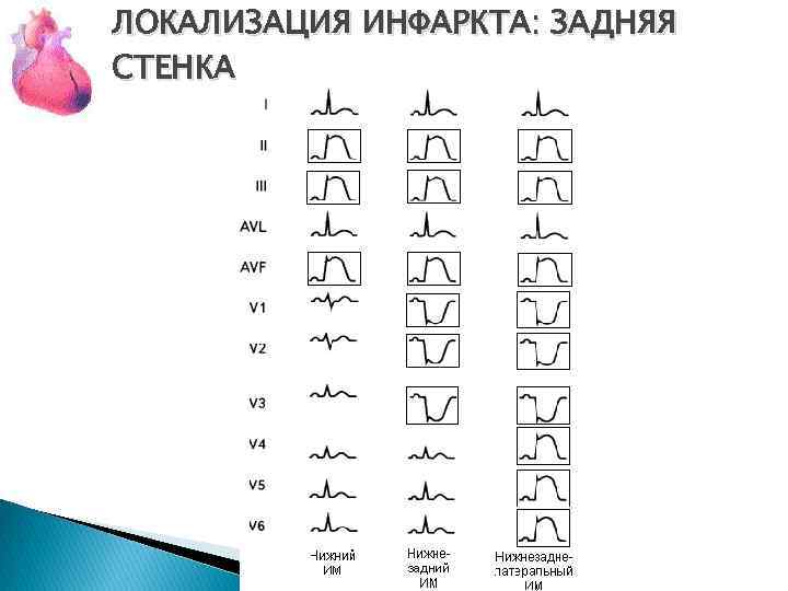 ЛОКАЛИЗАЦИЯ ИНФАРКТА: ЗАДНЯЯ СТЕНКА 