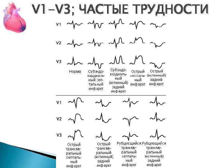 V 1 -V 3; ЧАСТЫЕ ТРУДНОСТИ 