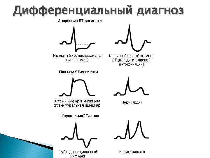 Субэндокардиальная экг