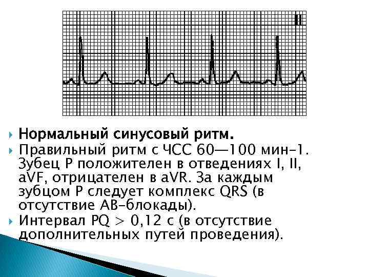  Нормальный синусовый ритм. Правильный ритм с ЧСС 60— 100 мин– 1. Зубец P