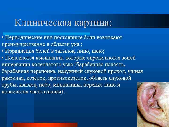 Клиническая картина: • Периодические или постоянные боли возникают преимущественно в области уха ; •
