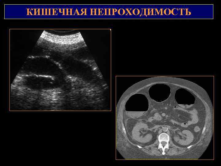 КИШЕЧНАЯ НЕПРОХОДИМОСТЬ 2 1 