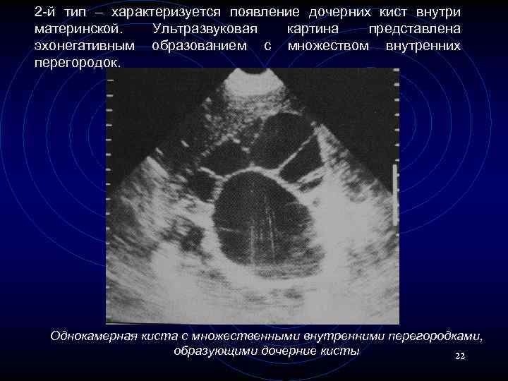 Характеристика эхонегативного изображения