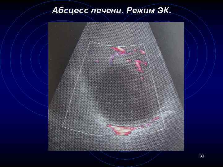 Абсцесс печени. Режим ЭК. 31 
