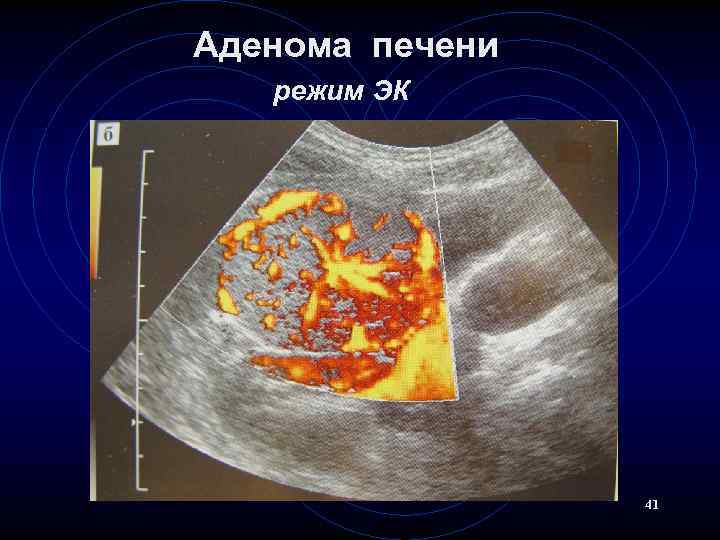 Аденома печени режим ЭК 41 
