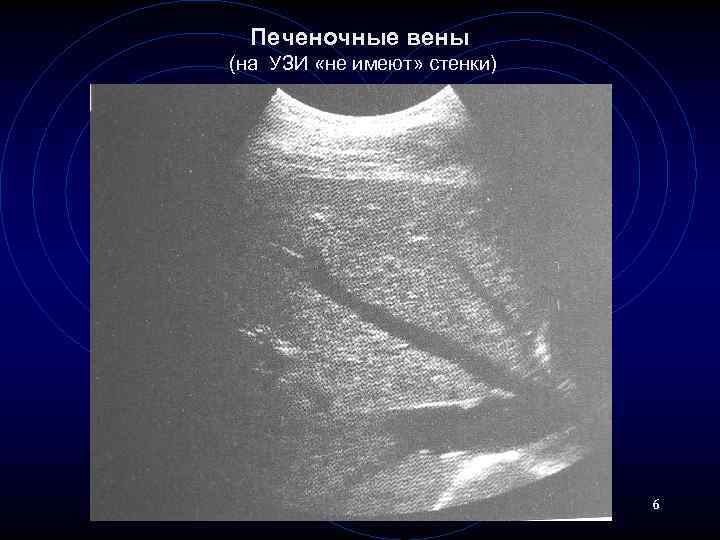 Печеночные вены (на УЗИ «не имеют» стенки) 6 