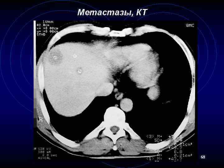 Метастазы, КТ 68 