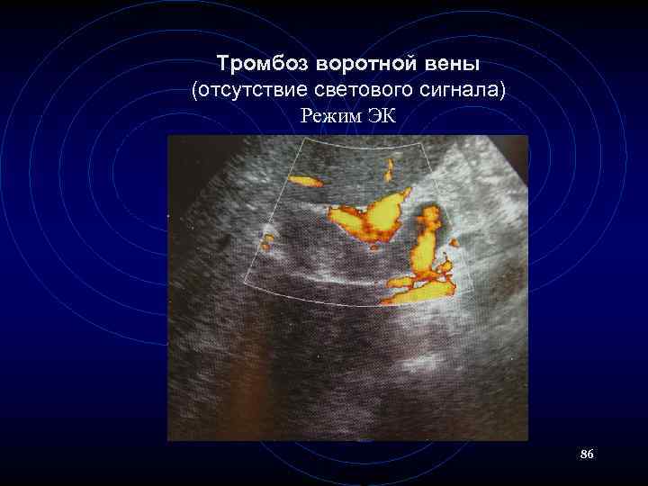 Тромбоз воротной вены (отсутствие светового сигнала) Режим ЭК 86 