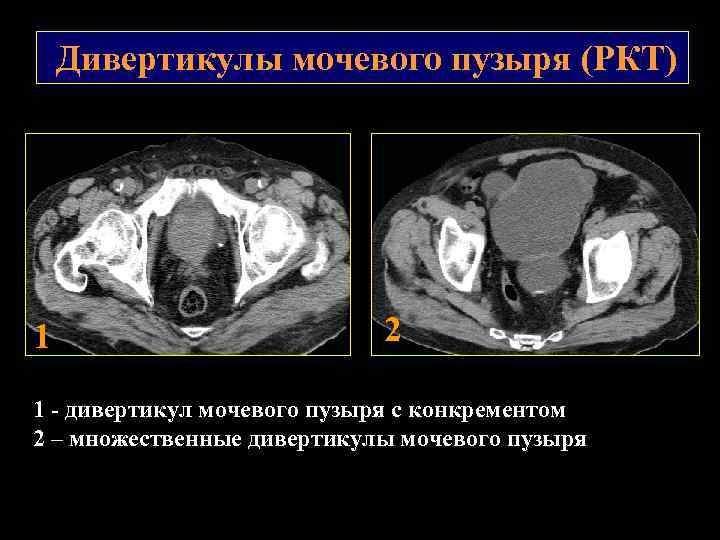 Камни мочевого пузыря мкб