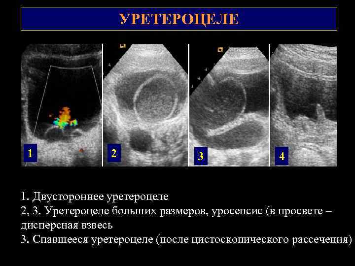 Уретроцеле у женщин фото