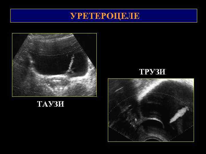 Уретроцеле у женщин фото