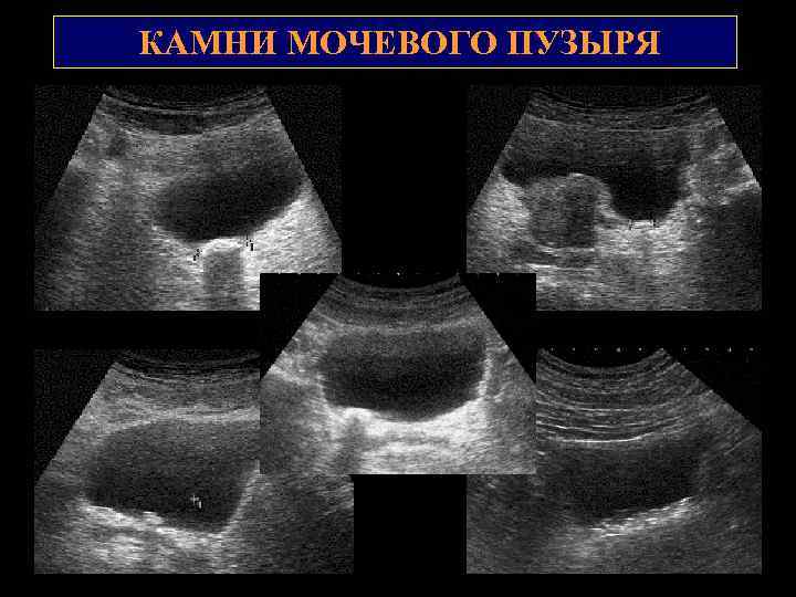 Камни на узи не видны. Конкременты мочевого пузыря. Камни в мочевом пузыре УЗИ. Конкременты мочевого пузыря на УЗИ. Снимок мочевого пузыря УЗИ.