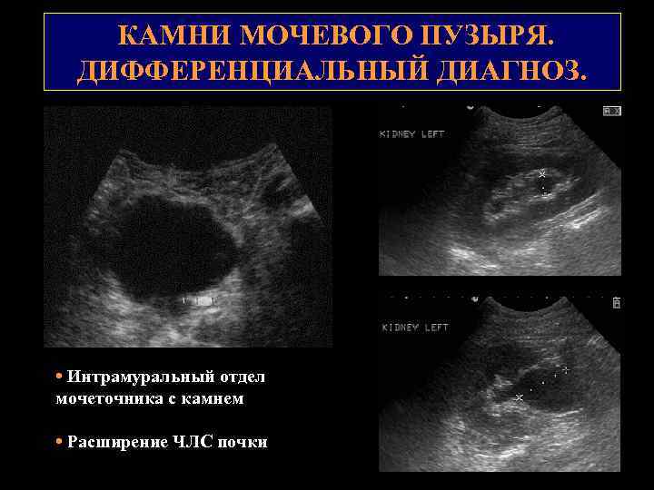 КАМНИ МОЧЕВОГО ПУЗЫРЯ. ДИФФЕРЕНЦИАЛЬНЫЙ ДИАГНОЗ. • Интрамуральный отдел мочеточника с камнем • Расширение ЧЛС