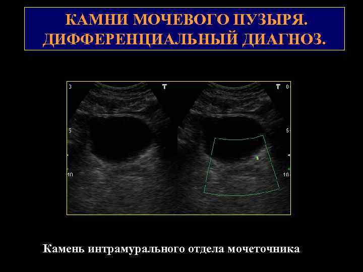 КАМНИ МОЧЕВОГО ПУЗЫРЯ. ДИФФЕРЕНЦИАЛЬНЫЙ ДИАГНОЗ. Камень интрамурального отдела мочеточника 