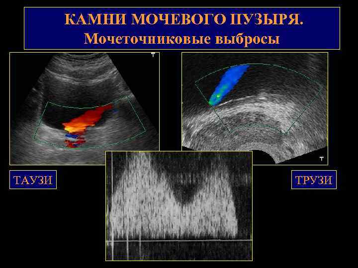 КАМНИ МОЧЕВОГО ПУЗЫРЯ. Мочеточниковые выбросы ТАУЗИ ТРУЗИ 