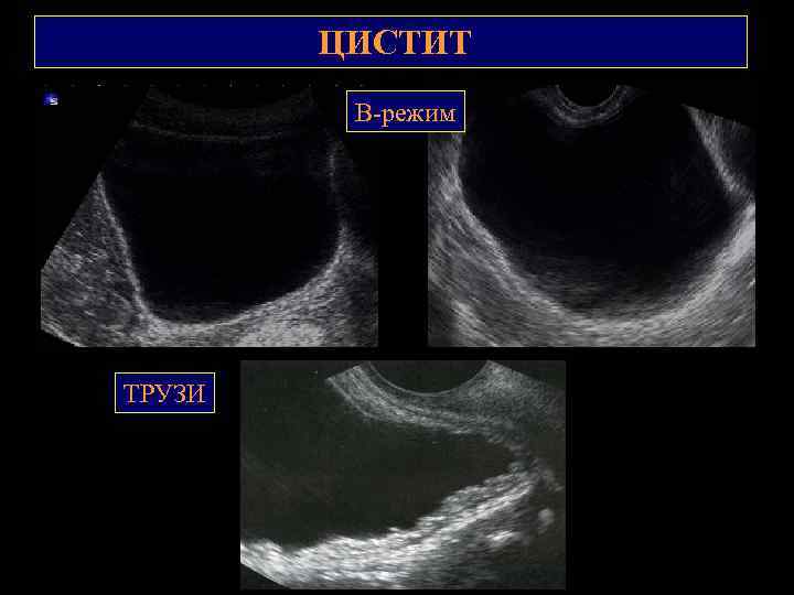 ЦИСТИТ В-режим ТРУЗИ 