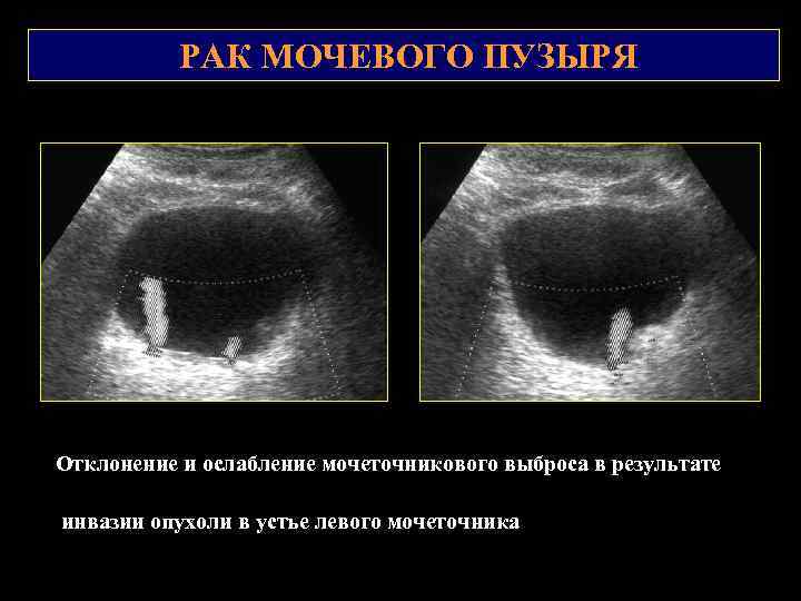 РАК МОЧЕВОГО ПУЗЫРЯ Отклонение и ослабление мочеточникового выброса в результате инвазии опухоли в устье