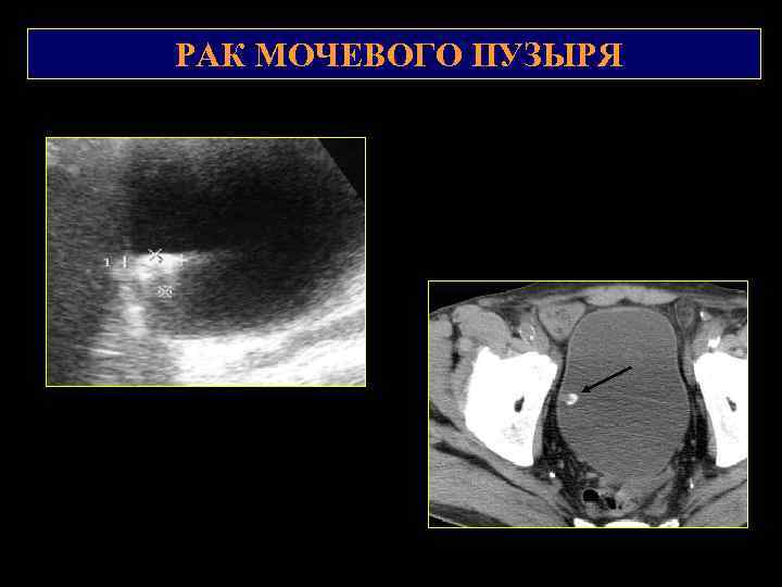 РАК МОЧЕВОГО ПУЗЫРЯ 