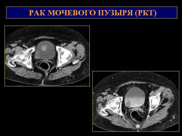РАК МОЧЕВОГО ПУЗЫРЯ (РКТ) 