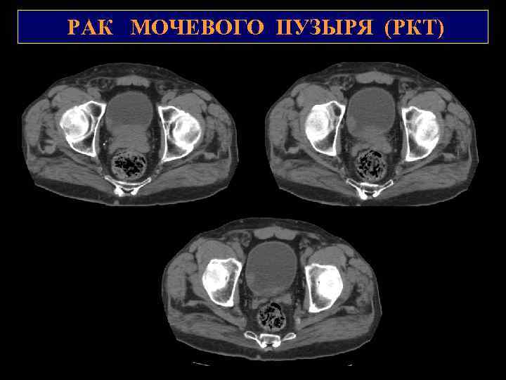 РАК МОЧЕВОГО ПУЗЫРЯ (РКТ) 