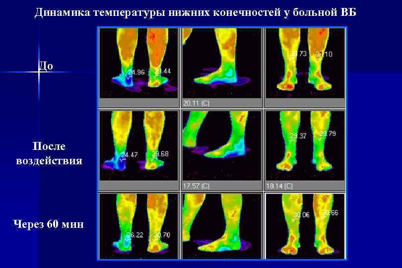 Динамика температуры нижних конечностей у больной ВБ До После воздействия Через 60 мин 