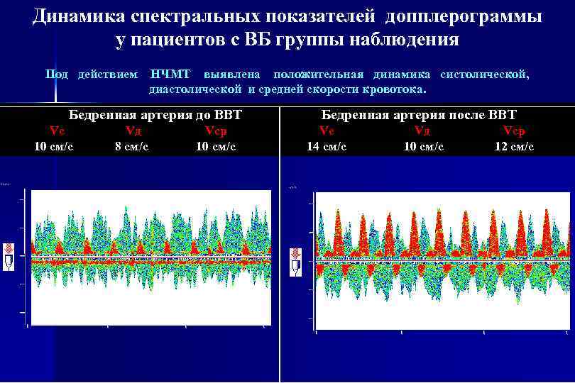 Динамика спектральных показателей допплерограммы у пациентов с ВБ группы наблюдения Под действием НЧМТ выявлена