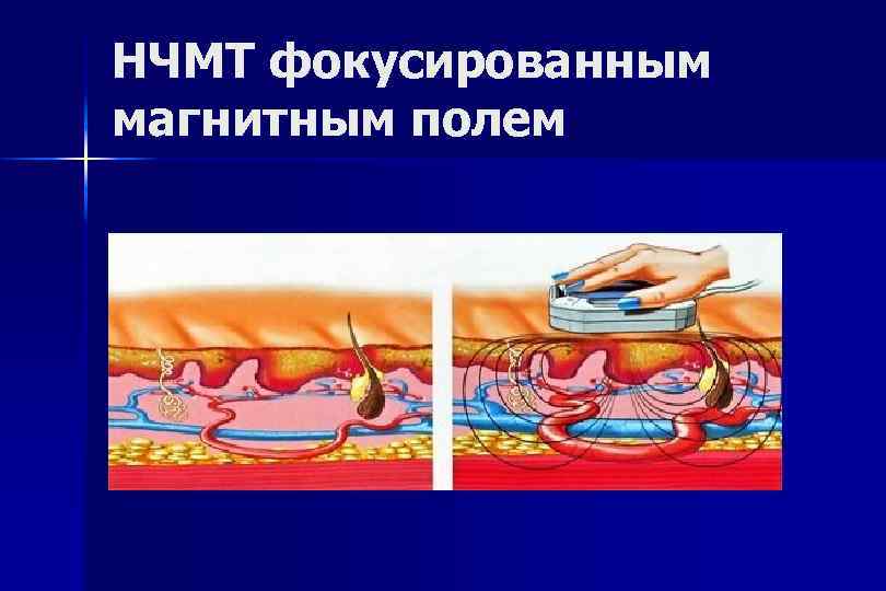 Низкочастотная магнитотерапия презентация