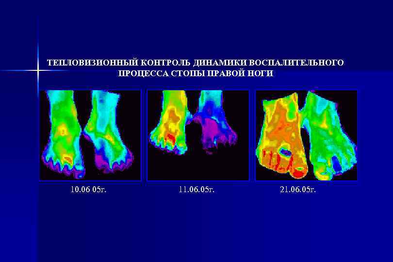 ТЕПЛОВИЗИОННЫЙ КОНТРОЛЬ ДИНАМИКИ ВОСПАЛИТЕЛЬНОГО ПРОЦЕССА СТОПЫ ПРАВОЙ НОГИ 10. 06 05 г. 11. 06.