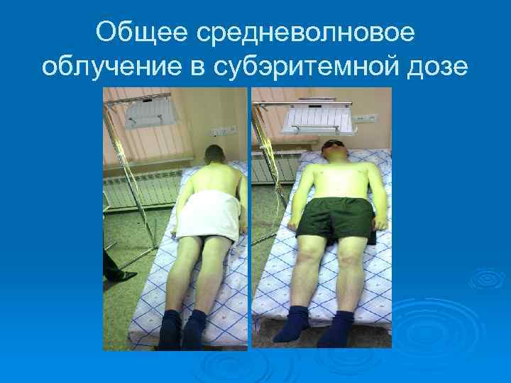 Общее средневолновое облучение в субэритемной дозе 