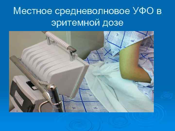 Местное средневолновое УФО в эритемной дозе 